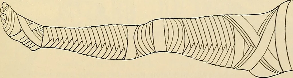 An illustration from Surgical technic; a text-book on operative surgery / by Fr. von Esmarch ... and E. Kowalzig ... translated by Professor Ludwig H. Grau ... and Willam N. Sullivan ... edited by Nicholas Senn ... With fourteen hundred and ninety-seven illustrations and fifteen colored plates., 1901, leaf 127