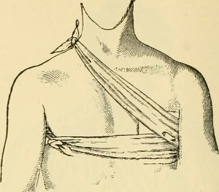An illustration from Surgical technic; a text-book on operative surgery / by Fr. von Esmarch ... and E. Kowalzig ... translated by Professor Ludwig H. Grau ... and Willam N. Sullivan ... edited by Nicholas Senn ... With fourteen hundred and ninety-seven illustrations and fifteen colored plates., 1901, leaf 136
