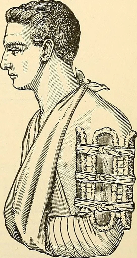 An illustration from Surgical technic; a text-book on operative surgery / by Fr. von Esmarch ... and E. Kowalzig ... translated by Professor Ludwig H. Grau ... and Willam N. Sullivan ... edited by Nicholas Senn ... With fourteen hundred and ninety-seven illustrations and fifteen colored plates., 1901, leaf 139