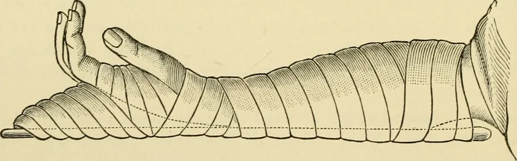 An illustration from Surgical technic; a text-book on operative surgery / by Fr. von Esmarch ... and E. Kowalzig ... translated by Professor Ludwig H. Grau ... and Willam N. Sullivan ... edited by Nicholas Senn ... With fourteen hundred and ninety-seven illustrations and fifteen colored plates., 1901, leaf 142