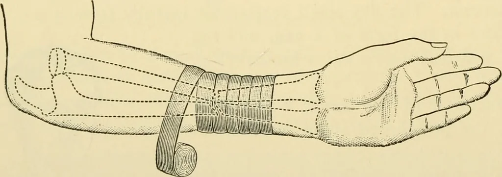 An illustration from Surgical technic; a text-book on operative surgery / by Fr. von Esmarch ... and E. Kowalzig ... translated by Professor Ludwig H. Grau ... and Willam N. Sullivan ... edited by Nicholas Senn ... With fourteen hundred and ninety-seven illustrations and fifteen colored plates., 1901, leaf 152