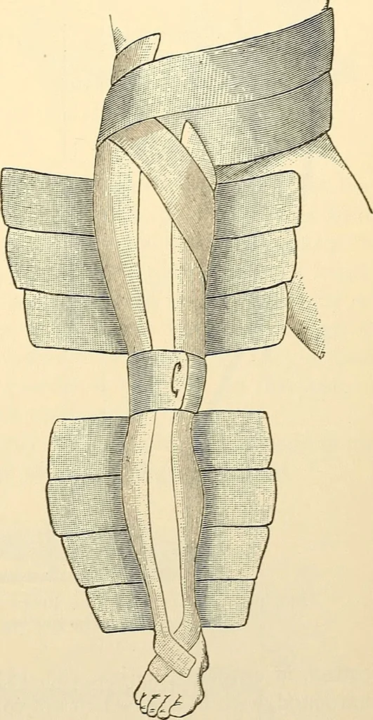 An illustration from Surgical technic; a text-book on operative surgery / by Fr. von Esmarch ... and E. Kowalzig ... translated by Professor Ludwig H. Grau ... and Willam N. Sullivan ... edited by Nicholas Senn ... With fourteen hundred and ninety-seven illustrations and fifteen colored plates., 1901, leaf 157