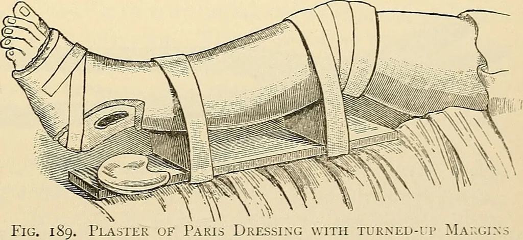 An illustration from Surgical technic; a text-book on operative surgery / by Fr. von Esmarch ... and E. Kowalzig ... translated by Professor Ludwig H. Grau ... and Willam N. Sullivan ... edited by Nicholas Senn ... With fourteen hundred and ninety-seven illustrations and fifteen colored plates., 1901, leaf 161