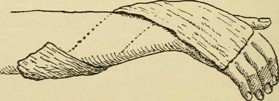 An illustration from Surgical technic; a text-book on operative surgery / by Fr. von Esmarch ... and E. Kowalzig ... translated by Professor Ludwig H. Grau ... and Willam N. Sullivan ... edited by Nicholas Senn ... With fourteen hundred and ninety-seven illustrations and fifteen colored plates., 1901, leaf 164