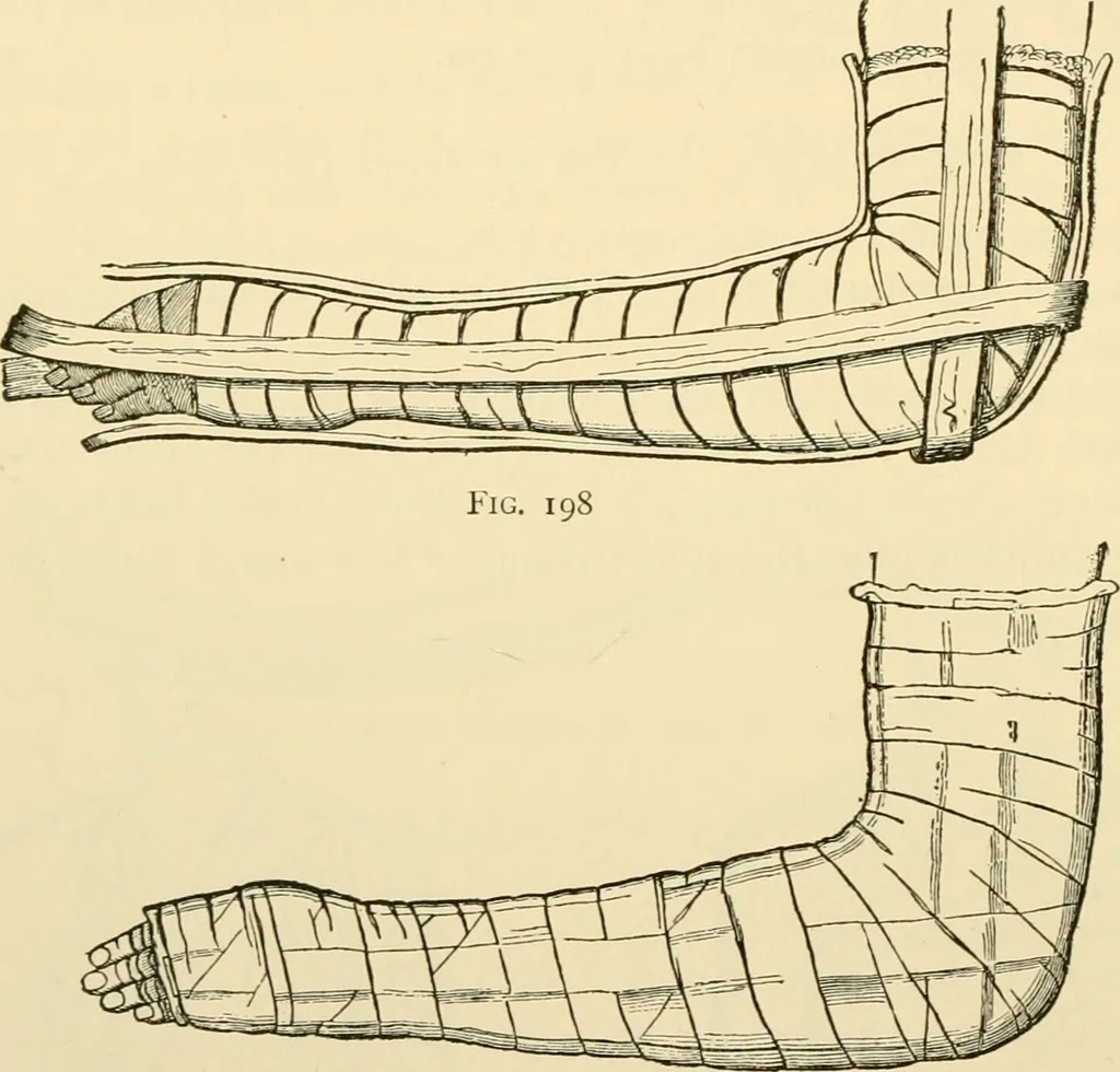 An illustration from Surgical technic; a text-book on operative surgery / by Fr. von Esmarch ... and E. Kowalzig ... translated by Professor Ludwig H. Grau ... and Willam N. Sullivan ... edited by Nicholas Senn ... With fourteen hundred and ninety-seven illustrations and fifteen colored plates., 1901, leaf 166