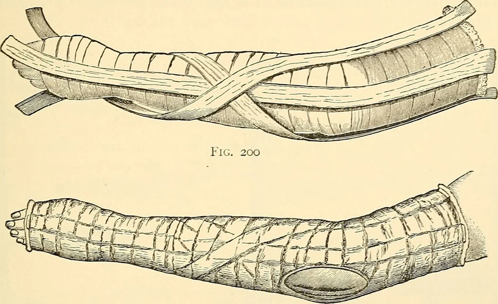 An illustration from Surgical technic; a text-book on operative surgery / by Fr. von Esmarch ... and E. Kowalzig ... translated by Professor Ludwig H. Grau ... and Willam N. Sullivan ... edited by Nicholas Senn ... With fourteen hundred and ninety-seven illustrations and fifteen colored plates., 1901, leaf 167