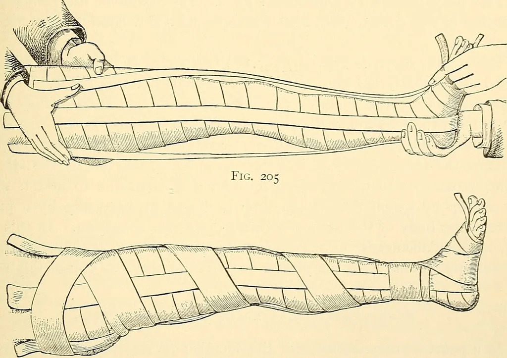 An illustration from Surgical technic; a text-book on operative surgery / by Fr. von Esmarch ... and E. Kowalzig ... translated by Professor Ludwig H. Grau ... and Willam N. Sullivan ... edited by Nicholas Senn ... With fourteen hundred and ninety-seven illustrations and fifteen colored plates., 1901, leaf 169