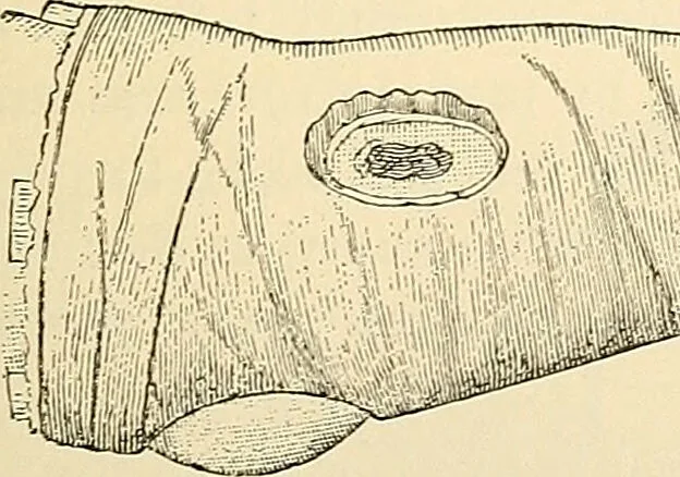An illustration from Surgical technic; a text-book on operative surgery / by Fr. von Esmarch ... and E. Kowalzig ... translated by Professor Ludwig H. Grau ... and Willam N. Sullivan ... edited by Nicholas Senn ... With fourteen hundred and ninety-seven illustrations and fifteen colored plates., 1901, leaf 169