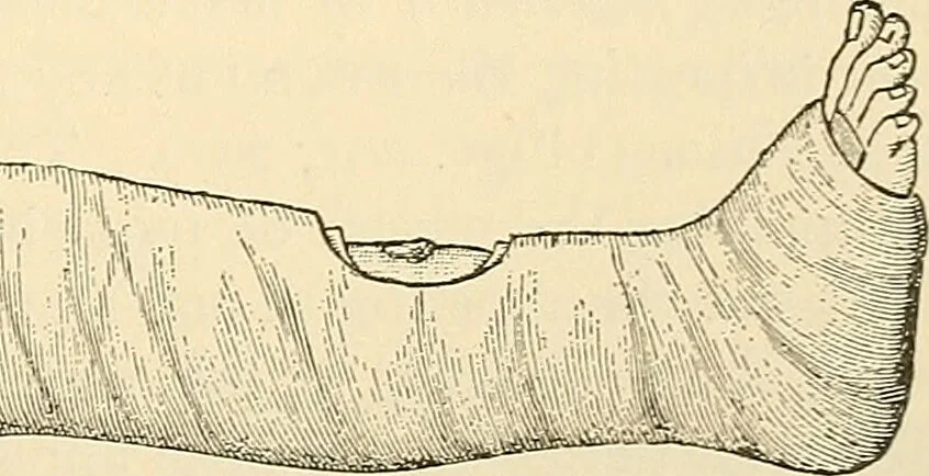 An illustration from Surgical technic; a text-book on operative surgery / by Fr. von Esmarch ... and E. Kowalzig ... translated by Professor Ludwig H. Grau ... and Willam N. Sullivan ... edited by Nicholas Senn ... With fourteen hundred and ninety-seven illustrations and fifteen colored plates., 1901, leaf 169