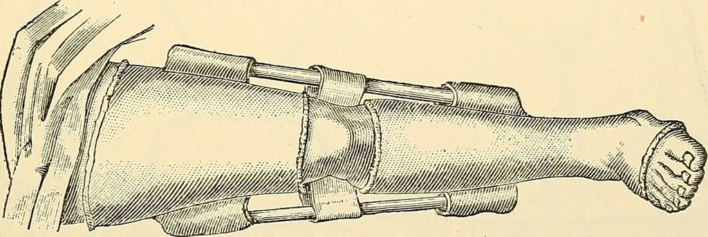 An illustration from Surgical technic; a text-book on operative surgery / by Fr. von Esmarch ... and E. Kowalzig ... translated by Professor Ludwig H. Grau ... and Willam N. Sullivan ... edited by Nicholas Senn ... With fourteen hundred and ninety-seven illustrations and fifteen colored plates., 1901, leaf 173