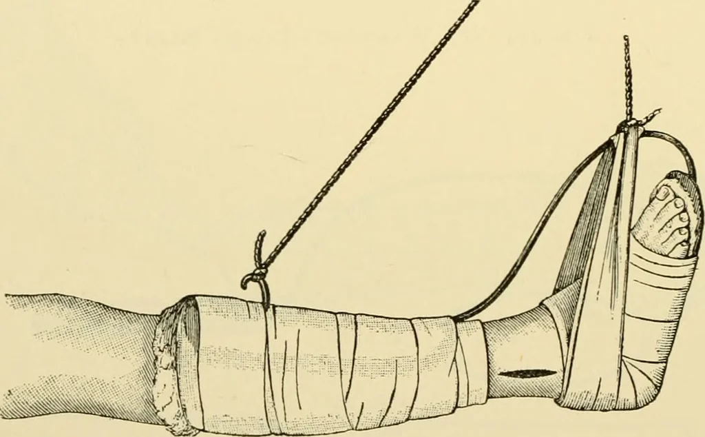 An illustration from Surgical technic; a text-book on operative surgery / by Fr. von Esmarch ... and E. Kowalzig ... translated by Professor Ludwig H. Grau ... and Willam N. Sullivan ... edited by Nicholas Senn ... With fourteen hundred and ninety-seven illustrations and fifteen colored plates., 1901, leaf 180