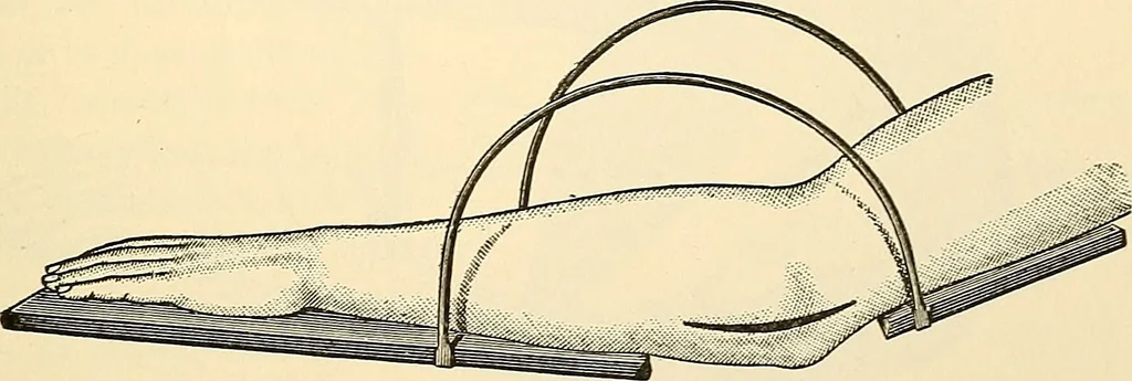 An illustration from Surgical technic; a text-book on operative surgery / by Fr. von Esmarch ... and E. Kowalzig ... translated by Professor Ludwig H. Grau ... and Willam N. Sullivan ... edited by Nicholas Senn ... With fourteen hundred and ninety-seven illustrations and fifteen colored plates., 1901, leaf 181