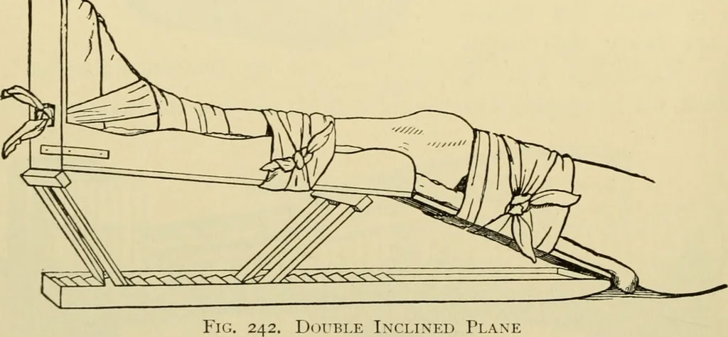 An illustration from Surgical technic; a text-book on operative surgery / by Fr. von Esmarch ... and E. Kowalzig ... translated by Professor Ludwig H. Grau ... and Willam N. Sullivan ... edited by Nicholas Senn ... With fourteen hundred and ninety-seven illustrations and fifteen colored plates., 1901, leaf 184