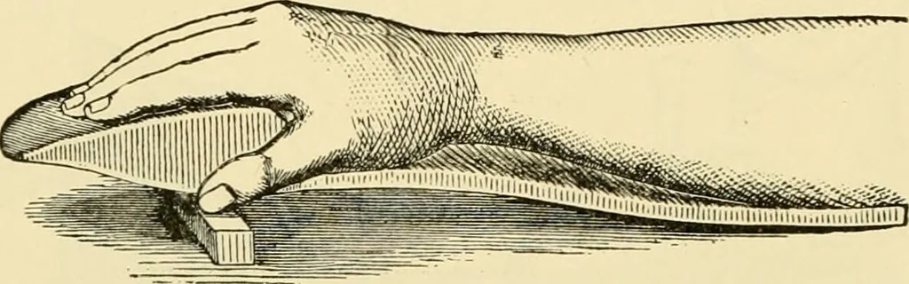 An illustration from Surgical technic; a text-book on operative surgery / by Fr. von Esmarch ... and E. Kowalzig ... translated by Professor Ludwig H. Grau ... and Willam N. Sullivan ... edited by Nicholas Senn ... With fourteen hundred and ninety-seven illustrations and fifteen colored plates., 1901, leaf 190