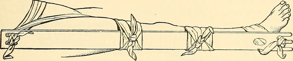 An illustration from Surgical technic; a text-book on operative surgery / by Fr. von Esmarch ... and E. Kowalzig ... translated by Professor Ludwig H. Grau ... and Willam N. Sullivan ... edited by Nicholas Senn ... With fourteen hundred and ninety-seven illustrations and fifteen colored plates., 1901, leaf 191