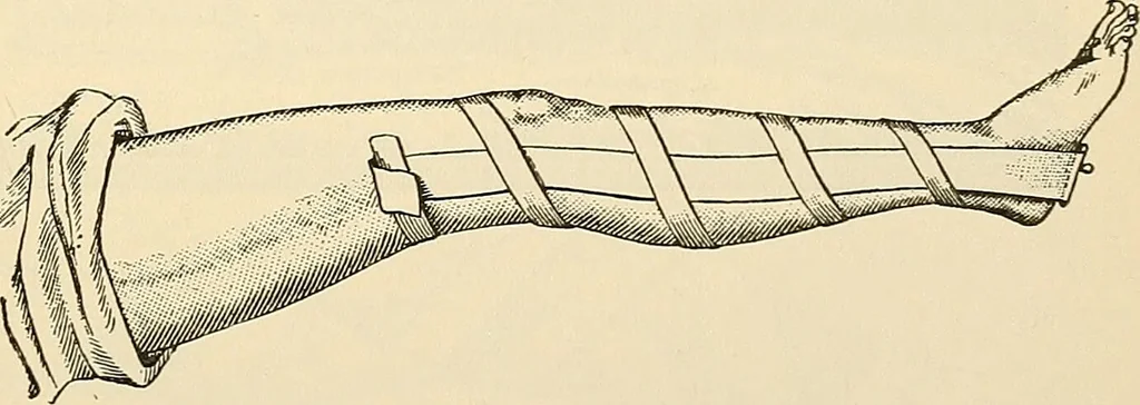An illustration from Surgical technic; a text-book on operative surgery / by Fr. von Esmarch ... and E. Kowalzig ... translated by Professor Ludwig H. Grau ... and Willam N. Sullivan ... edited by Nicholas Senn ... With fourteen hundred and ninety-seven illustrations and fifteen colored plates., 1901, leaf 191