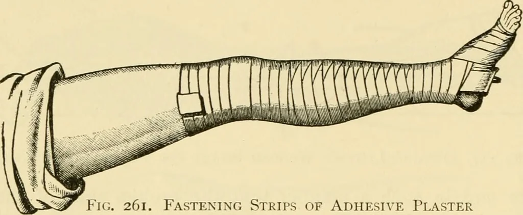 An illustration from Surgical technic; a text-book on operative surgery / by Fr. von Esmarch ... and E. Kowalzig ... translated by Professor Ludwig H. Grau ... and Willam N. Sullivan ... edited by Nicholas Senn ... With fourteen hundred and ninety-seven illustrations and fifteen colored plates., 1901, leaf 192