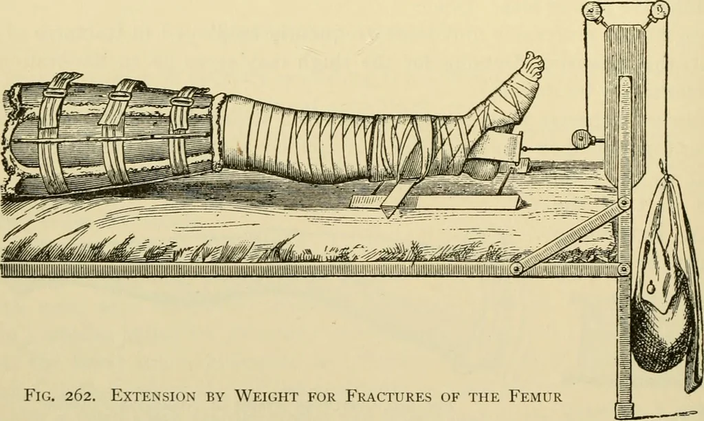 An illustration from Surgical technic; a text-book on operative surgery / by Fr. von Esmarch ... and E. Kowalzig ... translated by Professor Ludwig H. Grau ... and Willam N. Sullivan ... edited by Nicholas Senn ... With fourteen hundred and ninety-seven illustrations and fifteen colored plates., 1901, leaf 192