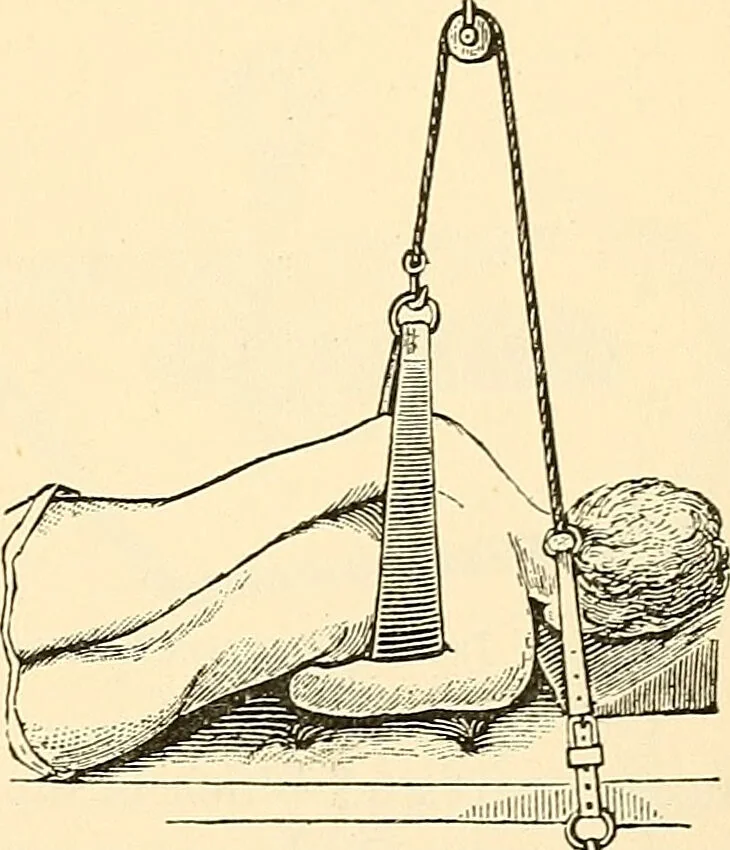 An illustration from Surgical technic; a text-book on operative surgery / by Fr. von Esmarch ... and E. Kowalzig ... translated by Professor Ludwig H. Grau ... and Willam N. Sullivan ... edited by Nicholas Senn ... With fourteen hundred and ninety-seven illustrations and fifteen colored plates., 1901, leaf 197