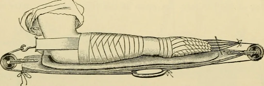 An illustration from Surgical technic; a text-book on operative surgery / by Fr. von Esmarch ... and E. Kowalzig ... translated by Professor Ludwig H. Grau ... and Willam N. Sullivan ... edited by Nicholas Senn ... With fourteen hundred and ninety-seven illustrations and fifteen colored plates., 1901, leaf 198