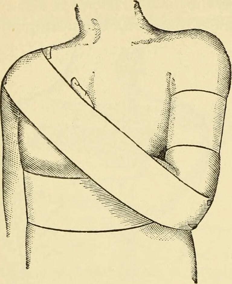 An illustration from Surgical technic; a text-book on operative surgery / by Fr. von Esmarch ... and E. Kowalzig ... translated by Professor Ludwig H. Grau ... and Willam N. Sullivan ... edited by Nicholas Senn ... With fourteen hundred and ninety-seven illustrations and fifteen colored plates., 1901, leaf 200