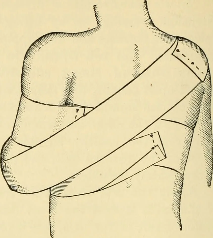 An illustration from Surgical technic; a text-book on operative surgery / by Fr. von Esmarch ... and E. Kowalzig ... translated by Professor Ludwig H. Grau ... and Willam N. Sullivan ... edited by Nicholas Senn ... With fourteen hundred and ninety-seven illustrations and fifteen colored plates., 1901, leaf 200