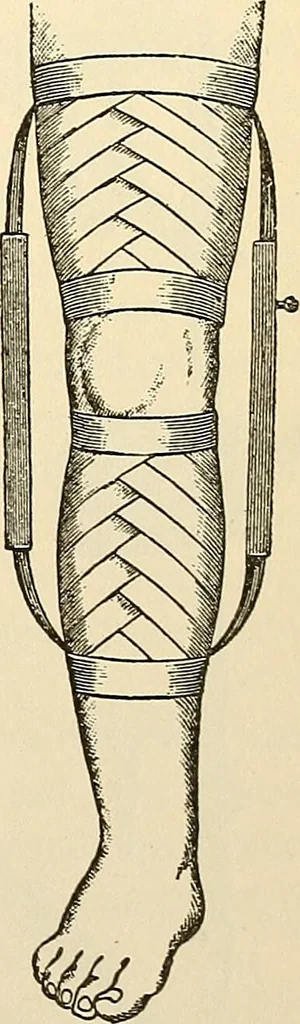 An illustration from Surgical technic; a text-book on operative surgery / by Fr. von Esmarch ... and E. Kowalzig ... translated by Professor Ludwig H. Grau ... and Willam N. Sullivan ... edited by Nicholas Senn ... With fourteen hundred and ninety-seven illustrations and fifteen colored plates., 1901, leaf 201