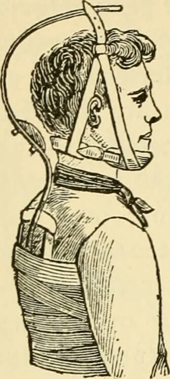 An illustration from Surgical technic; a text-book on operative surgery / by Fr. von Esmarch ... and E. Kowalzig ... translated by Professor Ludwig H. Grau ... and Willam N. Sullivan ... edited by Nicholas Senn ... With fourteen hundred and ninety-seven illustrations and fifteen colored plates., 1901, leaf 202
