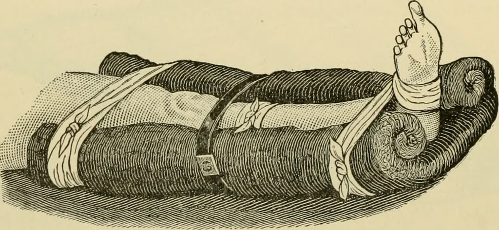 An illustration from Surgical technic; a text-book on operative surgery / by Fr. von Esmarch ... and E. Kowalzig ... translated by Professor Ludwig H. Grau ... and Willam N. Sullivan ... edited by Nicholas Senn ... With fourteen hundred and ninety-seven illustrations and fifteen colored plates., 1901, leaf 208