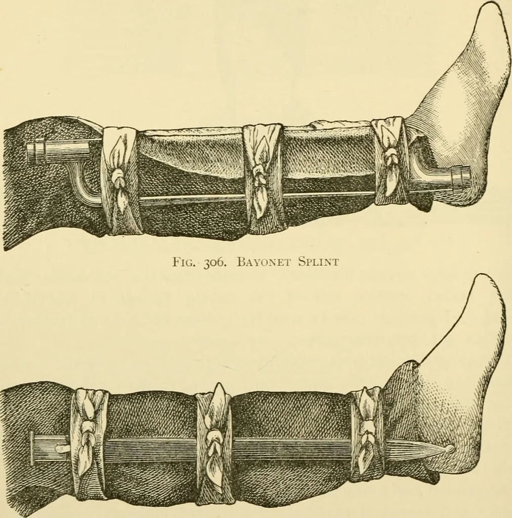 An illustration from Surgical technic; a text-book on operative surgery / by Fr. von Esmarch ... and E. Kowalzig ... translated by Professor Ludwig H. Grau ... and Willam N. Sullivan ... edited by Nicholas Senn ... With fourteen hundred and ninety-seven illustrations and fifteen colored plates., 1901, leaf 210