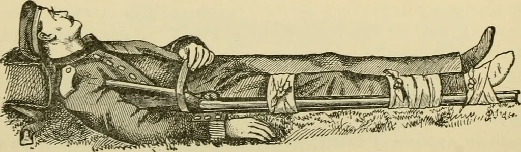 An illustration from Surgical technic; a text-book on operative surgery / by Fr. von Esmarch ... and E. Kowalzig ... translated by Professor Ludwig H. Grau ... and Willam N. Sullivan ... edited by Nicholas Senn ... With fourteen hundred and ninety-seven illustrations and fifteen colored plates., 1901, leaf 210