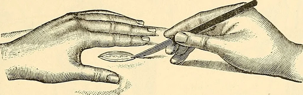 An illustration from Surgical technic; a text-book on operative surgery / by Fr. von Esmarch ... and E. Kowalzig ... translated by Professor Ludwig H. Grau ... and Willam N. Sullivan ... edited by Nicholas Senn ... With fourteen hundred and ninety-seven illustrations and fifteen colored plates., 1901, leaf 243