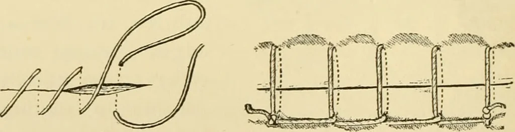 An illustration from Surgical technic; a text-book on operative surgery / by Fr. von Esmarch ... and E. Kowalzig ... translated by Professor Ludwig H. Grau ... and Willam N. Sullivan ... edited by Nicholas Senn ... With fourteen hundred and ninety-seven illustrations and fifteen colored plates., 1901, leaf 258