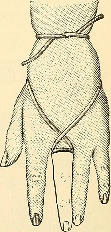 An illustration from Surgical technic; a text-book on operative surgery / by Fr. von Esmarch ... and E. Kowalzig ... translated by Professor Ludwig H. Grau ... and Willam N. Sullivan ... edited by Nicholas Senn ... With fourteen hundred and ninety-seven illustrations and fifteen colored plates., 1901, leaf 273