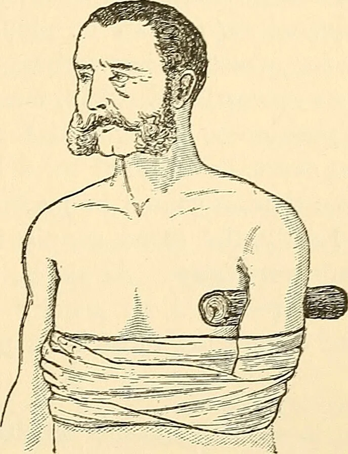 An illustration from Surgical technic; a text-book on operative surgery / by Fr. von Esmarch ... and E. Kowalzig ... translated by Professor Ludwig H. Grau ... and Willam N. Sullivan ... edited by Nicholas Senn ... With fourteen hundred and ninety-seven illustrations and fifteen colored plates., 1901, leaf 285