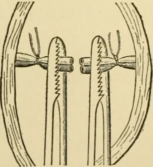 An illustration from Surgical technic; a text-book on operative surgery / by Fr. von Esmarch ... and E. Kowalzig ... translated by Professor Ludwig H. Grau ... and Willam N. Sullivan ... edited by Nicholas Senn ... With fourteen hundred and ninety-seven illustrations and fifteen colored plates., 1901, leaf 288