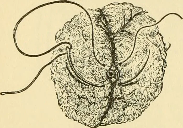 An illustration from Surgical technic; a text-book on operative surgery / by Fr. von Esmarch ... and E. Kowalzig ... translated by Professor Ludwig H. Grau ... and Willam N. Sullivan ... edited by Nicholas Senn ... With fourteen hundred and ninety-seven illustrations and fifteen colored plates., 1901, leaf 290