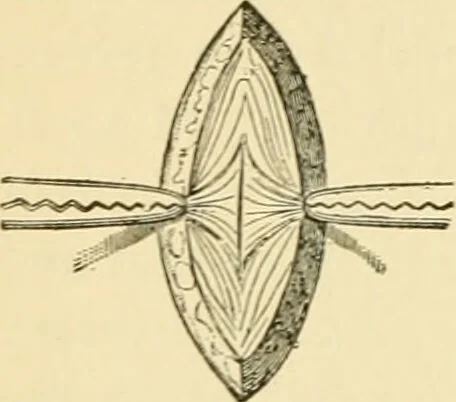 An illustration from Surgical technic; a text-book on operative surgery / by Fr. von Esmarch ... and E. Kowalzig ... translated by Professor Ludwig H. Grau ... and Willam N. Sullivan ... edited by Nicholas Senn ... With fourteen hundred and ninety-seven illustrations and fifteen colored plates., 1901, leaf 296