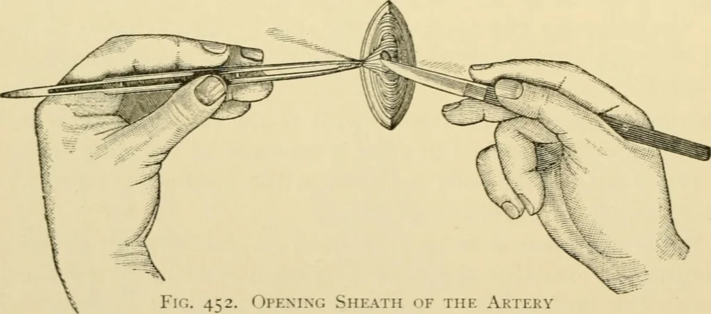 An illustration from Surgical technic; a text-book on operative surgery / by Fr. von Esmarch ... and E. Kowalzig ... translated by Professor Ludwig H. Grau ... and Willam N. Sullivan ... edited by Nicholas Senn ... With fourteen hundred and ninety-seven illustrations and fifteen colored plates., 1901, leaf 296