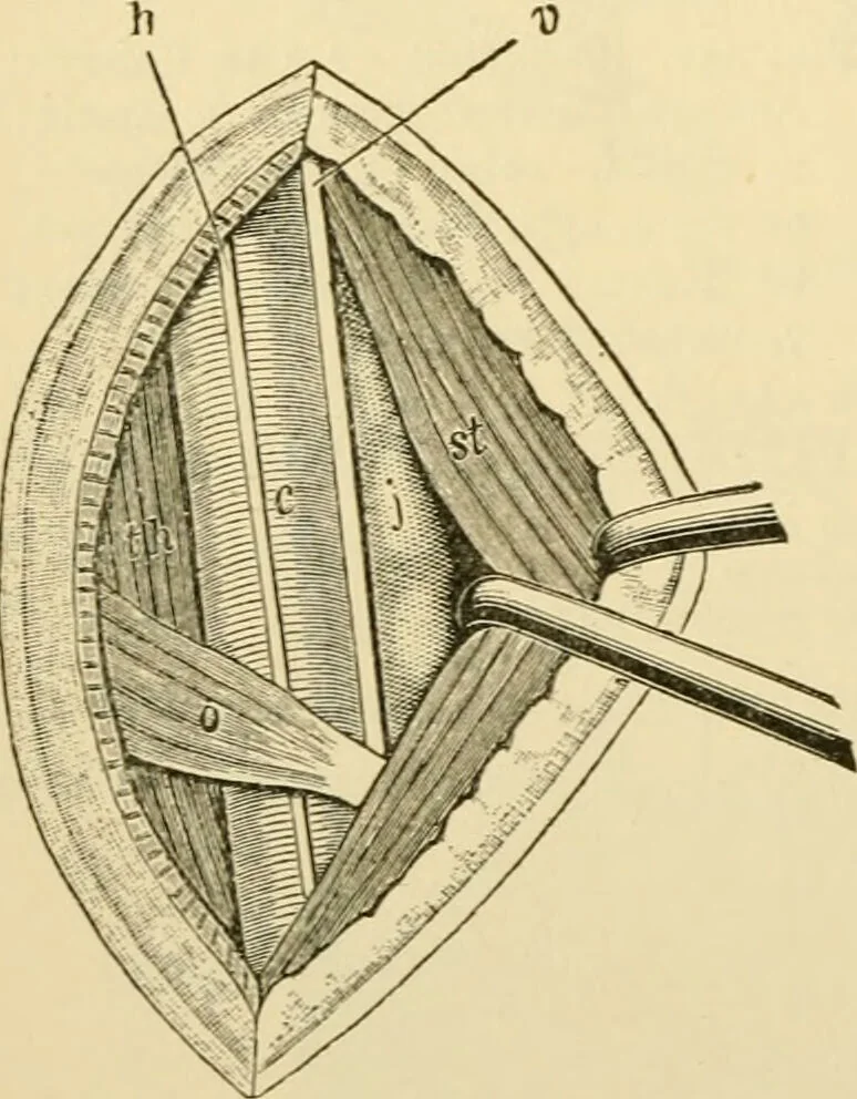An illustration from Surgical technic; a text-book on operative surgery / by Fr. von Esmarch ... and E. Kowalzig ... translated by Professor Ludwig H. Grau ... and Willam N. Sullivan ... edited by Nicholas Senn ... With fourteen hundred and ninety-seven illustrations and fifteen colored plates., 1901, leaf 300
