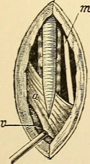 An illustration from Surgical technic; a text-book on operative surgery / by Fr. von Esmarch ... and E. Kowalzig ... translated by Professor Ludwig H. Grau ... and Willam N. Sullivan ... edited by Nicholas Senn ... With fourteen hundred and ninety-seven illustrations and fifteen colored plates., 1901, leaf 317