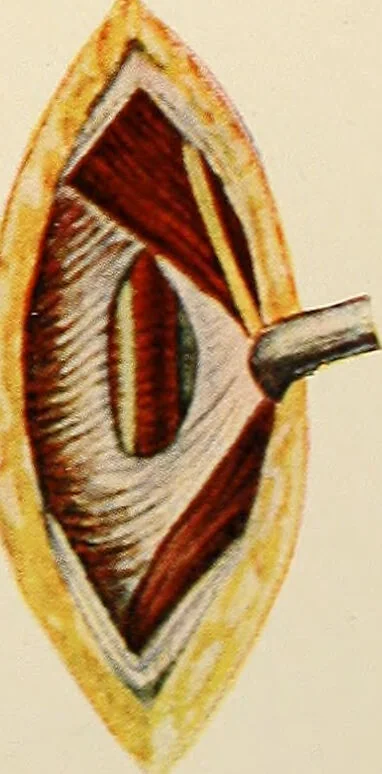An illustration from Surgical technic; a text-book on operative surgery / by Fr. von Esmarch ... and E. Kowalzig ... translated by Professor Ludwig H. Grau ... and Willam N. Sullivan ... edited by Nicholas Senn ... With fourteen hundred and ninety-seven illustrations and fifteen colored plates., 1901, leaf 327