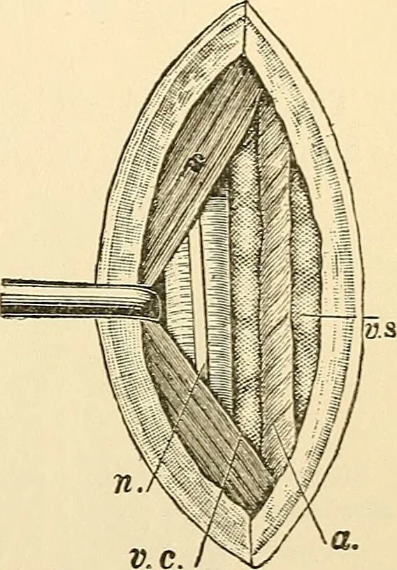 An illustration from Surgical technic; a text-book on operative surgery / by Fr. von Esmarch ... and E. Kowalzig ... translated by Professor Ludwig H. Grau ... and Willam N. Sullivan ... edited by Nicholas Senn ... With fourteen hundred and ninety-seven illustrations and fifteen colored plates., 1901, leaf 333