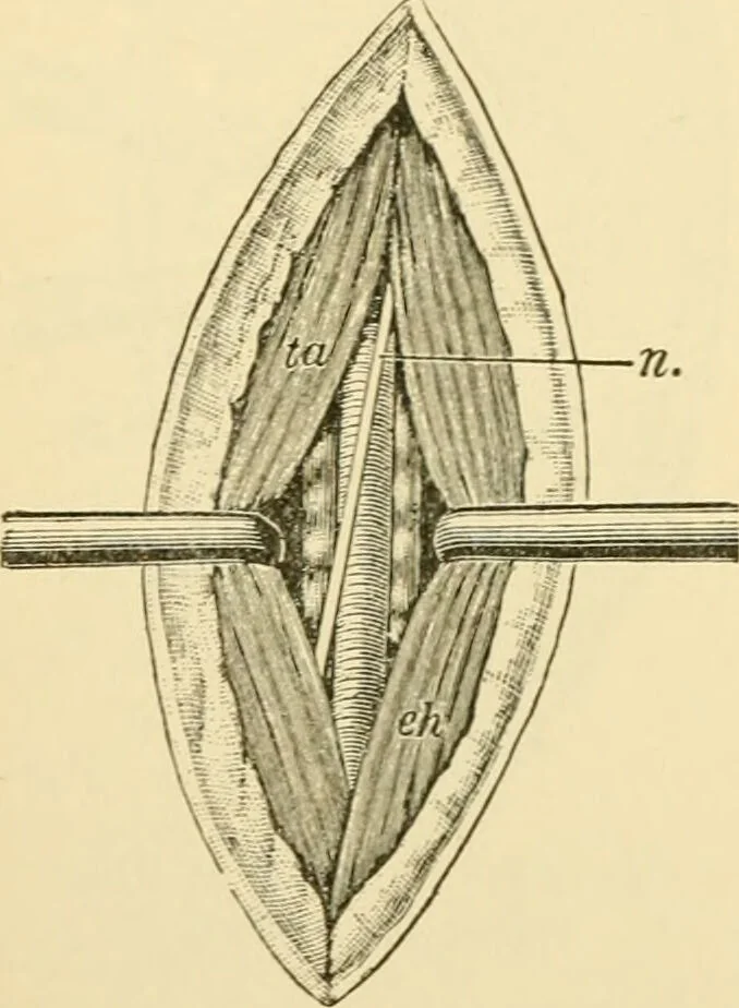 An illustration from Surgical technic; a text-book on operative surgery / by Fr. von Esmarch ... and E. Kowalzig ... translated by Professor Ludwig H. Grau ... and Willam N. Sullivan ... edited by Nicholas Senn ... With fourteen hundred and ninety-seven illustrations and fifteen colored plates., 1901, leaf 338