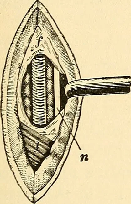 An illustration from Surgical technic; a text-book on operative surgery / by Fr. von Esmarch ... and E. Kowalzig ... translated by Professor Ludwig H. Grau ... and Willam N. Sullivan ... edited by Nicholas Senn ... With fourteen hundred and ninety-seven illustrations and fifteen colored plates., 1901, leaf 341