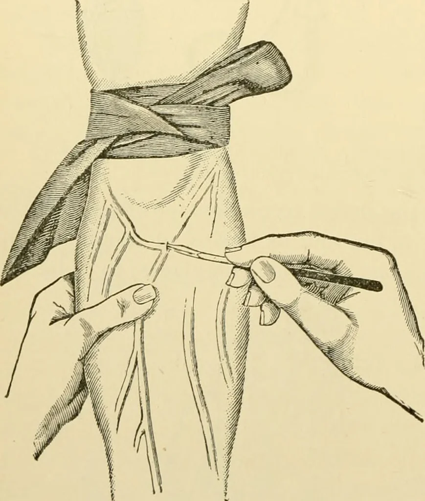 An illustration from Surgical technic; a text-book on operative surgery / by Fr. von Esmarch ... and E. Kowalzig ... translated by Professor Ludwig H. Grau ... and Willam N. Sullivan ... edited by Nicholas Senn ... With fourteen hundred and ninety-seven illustrations and fifteen colored plates., 1901, leaf 346