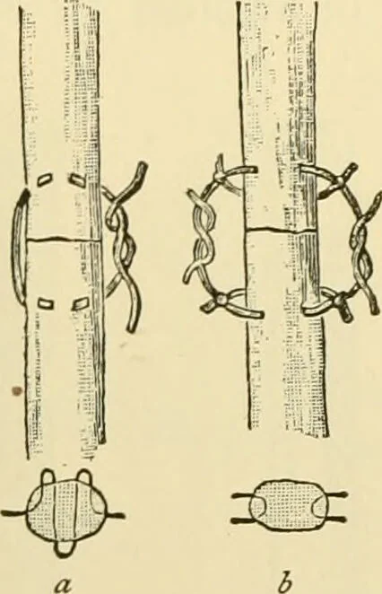 An illustration from Surgical technic; a text-book on operative surgery / by Fr. von Esmarch ... and E. Kowalzig ... translated by Professor Ludwig H. Grau ... and Willam N. Sullivan ... edited by Nicholas Senn ... With fourteen hundred and ninety-seven illustrations and fifteen colored plates., 1901, leaf 358