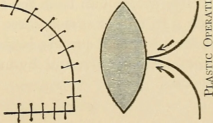 An illustration from Surgical technic; a text-book on operative surgery / by Fr. von Esmarch ... and E. Kowalzig ... translated by Professor Ludwig H. Grau ... and Willam N. Sullivan ... edited by Nicholas Senn ... With fourteen hundred and ninety-seven illustrations and fifteen colored plates., 1901, leaf 367