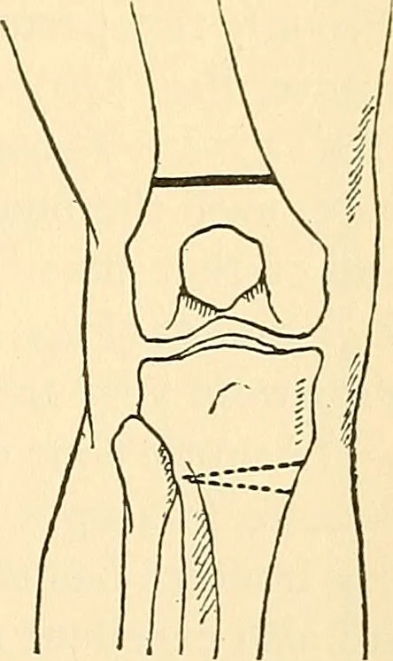 An illustration from Surgical technic; a text-book on operative surgery / by Fr. von Esmarch ... and E. Kowalzig ... translated by Professor Ludwig H. Grau ... and Willam N. Sullivan ... edited by Nicholas Senn ... With fourteen hundred and ninety-seven illustrations and fifteen colored plates., 1901, leaf 373