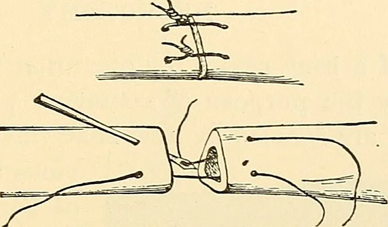 An illustration from Surgical technic; a text-book on operative surgery / by Fr. von Esmarch ... and E. Kowalzig ... translated by Professor Ludwig H. Grau ... and Willam N. Sullivan ... edited by Nicholas Senn ... With fourteen hundred and ninety-seven illustrations and fifteen colored plates., 1901, leaf 375